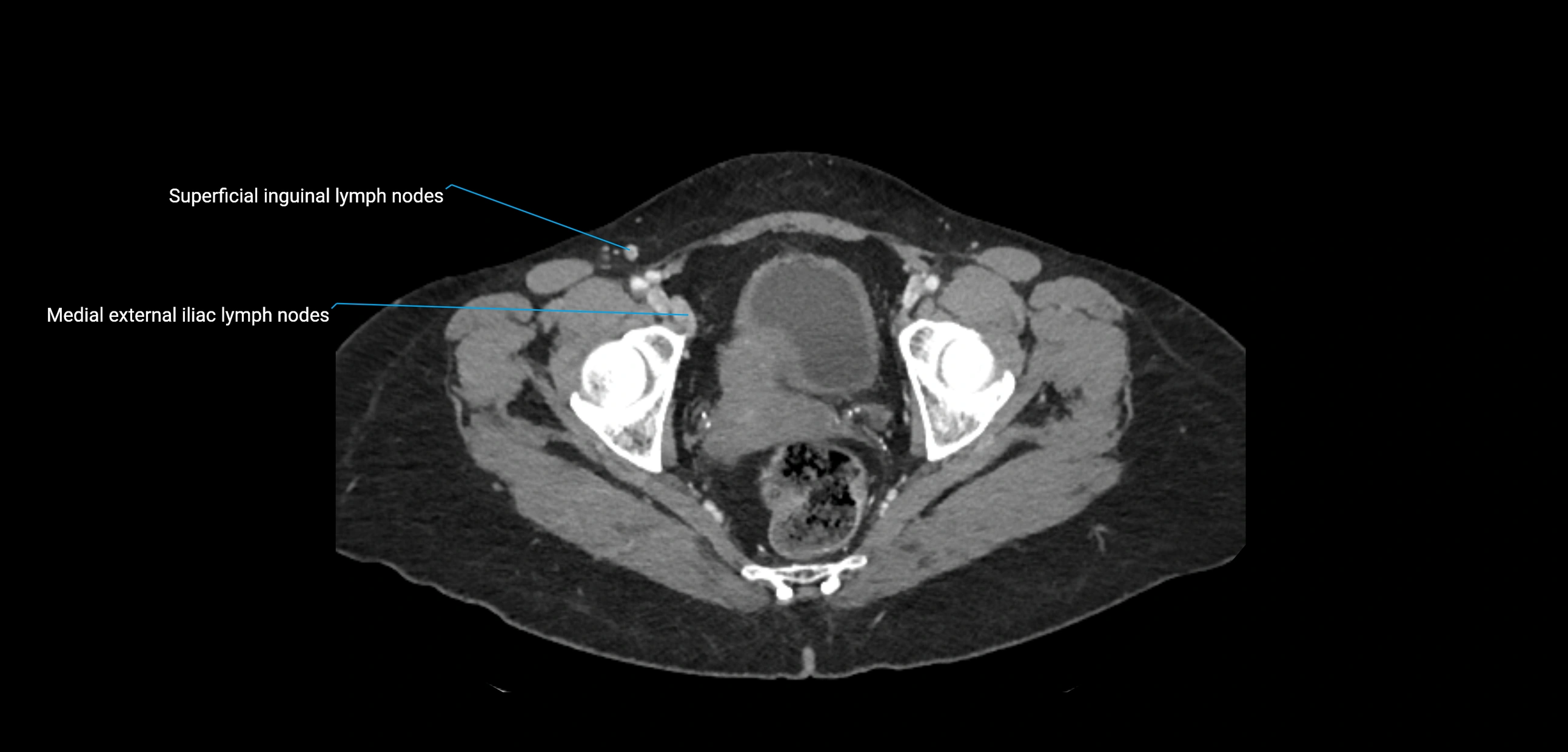 CT ct abdominal lymph nodes  axial cross sectional anatomy  enchanced radiology image -img-00002-00381.webp